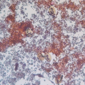 P_kellicottii_BAL100x_Prokop.jpg Figure C: Egg of <em>P. kellicotti</em> in a Pap-stained bronchial alveolar lavage (BAL) specimen at 100x magnification. Image courtesy of Dr. Gary Procop.