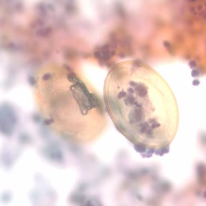 P_kellicottii_BAL400x_Prokop.jpg Figure D: Eggs of <em>P. kellicotti</em> in a Pap-stained bronchial alveolar lavage (BAL) specimen at 400x magnification. Image courtesy of Dr. Gary Procop.
