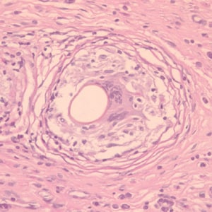 P_kellicottii_OK200x_ProkopA.jpg Figure A: Cross-section of an egg of <em>P. kellicotti</em> in a lung biopsy specimen, stained with periodic acid-Schiff (PAS) stain. Image courtesy of Dr. Gary Procop.