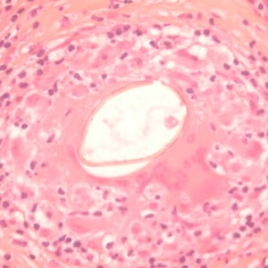 P_kellicottii_OK400x_ProkopA.jpg Figure B: Longitudinal section of an egg of <em>P. kellicotti</em> in a lung biopsy specimen, stained with hematoxylin and eosin (H&E). Image courtesy of Dr. Gary Procop.