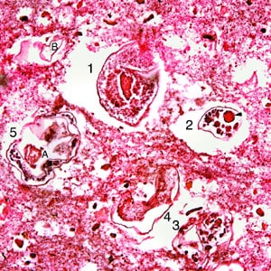 P_kellicotti_lung1.jpg Figure F: Sections of several adults of <em>P. kellicotti</em> taken from a pleural biopsy stained with H&E. Numbers 1-5 show the individual worms. The integument is gone from most of the worms, as this was probably an old infection, but remnants of the gonad (A, dart) and uterine tubes (B) can be seen. Image courtesy of Dr. Miguel Madariaga, University of Nebraska Medical Center. Image first appeared in: Madariaga, MD, M. G., T. Ruma, MD, and J. H. Theis, MD. 2007. Autochthonous human paragonimiasis in North America. Wilderness & Environmental Medicine. 18(3): 203-205. Image used with permission of © Allen Press Publishing Services.