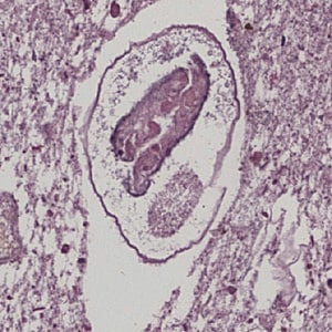 P_kellicotti_lung2.jpg Figure E: Adult of <em>P. kellicotti</em> taken from a lung biopsy specimen stained with H&E. This worm is in poor condition, indicating it was probably an old infection. Image courtesy of Dr. Miguel Madariaga, University of Nebraska Medical Center.