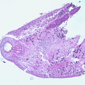 Paragonimus_oral_sucker.jpg Figure C: Adult of <em>Paragonimus</em> sp., taken from a lung biopsy specimen stained with hematoxylin and eosin (H&E). Note the presence of the oral sucker. The species was not identified in this case.