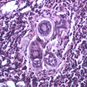 Figure E: Eggs of <em>S. haematobium</em> in a urinary bladder biopsy specimen, stained with H&E. Images courtesy of the Michael E. DeBakey V. A. Medical Center, Houston, TX.