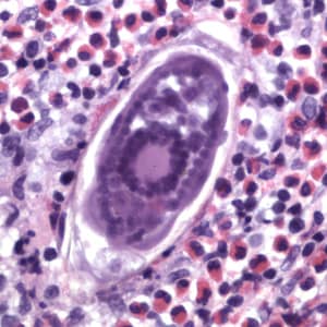 Figure F: Egg of <em>S. haematobium</em> in a urinary bladder biopsy specimen, stained with H&E. Images courtesy of the Michael E. DeBakey V. A. Medical Center, Houston, TX.