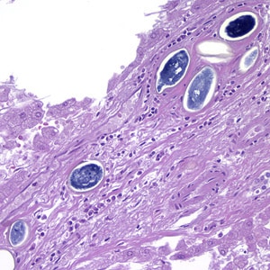 Figure C: Eggs of <em>S. japonicum</em> from tissue, stained with H&E. at 200x magnification.