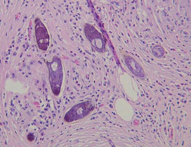 Figure A: Eggs of <em>S. mansoni</em> in liver tissue, stained with H&E. Images courtesy of Dr. Munaf Desai, Al Qassini Hospital, Shatjah, United Arab Emirates.