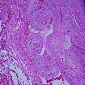 Figure C: Adults of <em>Schistosoma</em> spp. in lung tissue, stained with H&E. Images courtesy of Harvard Medical School, Cambridge, MA.