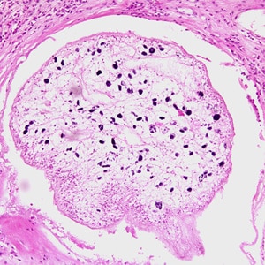 Figure A: Proliferating sparganum in groin tissue of a patient from Paraguay, stained with hematoxylin and eosin (H&E).