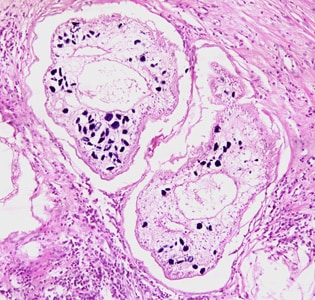 Figure B: Proliferating spargana in groin tissue of a patient from Paraguay, stained with hematoxylin and eosin (H&E).