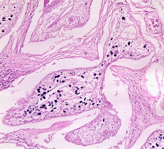Figure C: Proliferating sparganum in groin tissue of a patient from Paraguay, stained with hematoxylin and eosin (H&E).