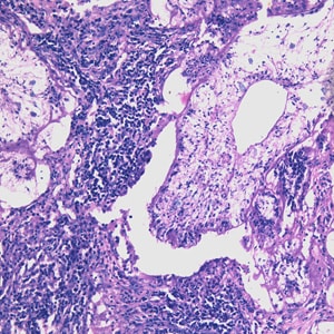 Figure A: Proliferating sparganum in lung tissue in a patient from Taiwan, stained with hematoxylin and eosin (H&E).