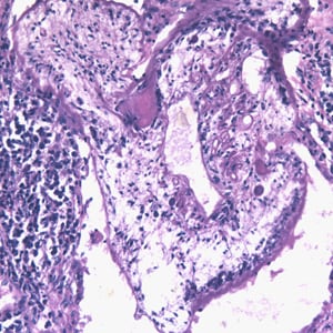 Figure C: Proliferating sparganum in lung tissue in a patient from Taiwan, stained with H&E.