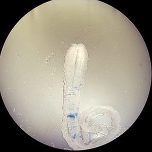 Figure B: Sparganum removed from the chest wall of a patient. The worm measured about 70 mm long. Images from a specimen courtesy of the Oklahoma State Department of Health.