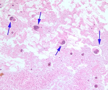 S_stercoralis_HE_200x_BAM1.jpg Figure A: Cross-sections of adult parasitic female <em>S. stercoralis</em> (blue arrows) in small intestine tissue, stained with H&E. Image taken at 200x magnification.