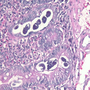 Strongyloides_duodenal_biopsy_HE200x.jpg Figure B: Sections of <em>S. stercoralis</em> from a duodenal biopsy specimen, stained with H&E. Although strongyloidiasis could not be confirmed based on microscopy alone, this case was confirmed using molecular methods (PCR). Image taken at 200x magnification.