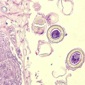 Figure D: Higher magnification of the image in Figure B, showing a close-up of the eggs. Note the characteristic striations, typical for the taeniids. Not visible in these images are the hooks commonly seen in cestode eggs. Hooks do not stain with H&E but are refractile and are visible with fine focusing of the microscope.