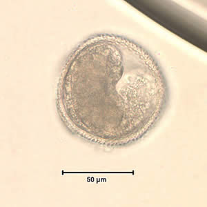 Toxocara_egg_wtmt.jpg Figure A: <em>Toxocara</em> sp. egg teased from an adult worm. The worm was never identified, but the egg size is most consistent with T. cati. Image courtesy of the New Jersey State Public Health Laboratory.