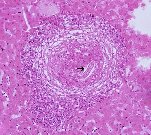 Toxo_canis_liver Figure D. <em>Toxocara canis</em> longitudinal section (arrow) in the liver of an infected monkey. Note the prominent granulomatous reaction and host infiltrate around the larva (20x magnification).