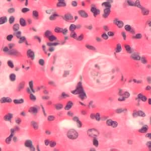 Toxocara_larvae_he.jpg Figure A: Cross-section of <em>Toxocara</em> sp. larvae in liver tissue stained with hematoxylin and eosin (H&E).