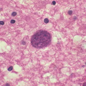T_gondii_cyst_brain.jpg Figure A: <em>Toxoplasma gondii</em> cyst in brain tissue stained with hematoxylin and eosin.
