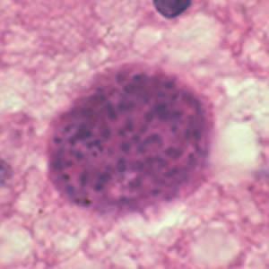 T_gondii_cyst_brain2.jpg Figure B: <em>Toxoplasma gondii</em> cyst stained with hematoxylin and eosin.