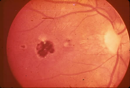 Congen_Toxo_ocular.jpg Figure C: Central, healed retinochoroiditis.