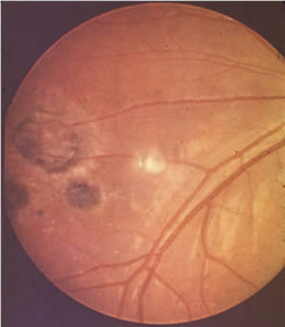 Congen_Toxo_ocular2.jpg Figure B: Peripheral retinochoroiditis.