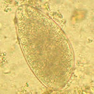 Figure B: Egg of a <em>Trichostrongyle</em> in an unstained wet mount of stool from a patient from Afghanistan. Eggs ranged in size from 87-92 µm in length by 50-55 µm in width. Images courtesy of the Leiden University Medical Center, The Netherlands.