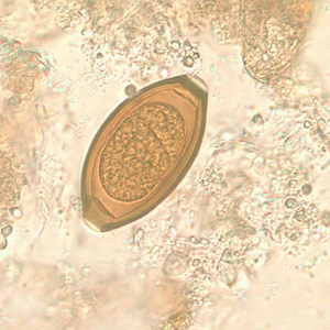 Figure B: Egg of <em>T. trichiura</em> in an unstained wet mount.