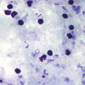 Tcruzi_thick_giemsa2.jpg Figure B: <em>T. cruzi</em> trypomastigotes in a thick blood smear stained with Giemsa.
