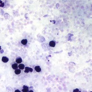 Tcruzi_thick_giemsa3.jpg Figure C: <em>T. cruzi</em> trypomastigotes in a thick blood smear stained with Giemsa.