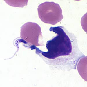 Tcruzi_CSF_giemsa.jpg Figure A: <em>Trypanosoma cruzi</em> trypomastigote in cerebrospinal fluid (CSF) stained with Giemsa.