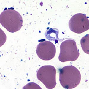 Tcruzi_CSF_giemsa2.jpg Figure B: <em>Trypanosoma cruzi</em> trypomastigote in cerebrospinal fluid (CSF) stained with Giemsa.