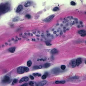 Tcruzi_tissue_he.jpg Figure A: <em>Trypanosoma cruzi</em> amastigotes in heart tissue. The section is stained with hematoxylin and eosin (H&E).