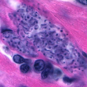Tcruzi_tissue_he3_zoom.jpg Figure F: Higher magnification of Figure E. The amastigotes in this image appear to be transforming into trypomastigotes.