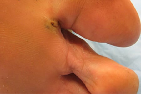 Figure A: Gross lesion on a patient's foot caused by <em>T. penetrans</em>. Image courtesy of Drs. Mohammed Asmal and Rocio M. Hurtado. Image first appeared at Partners' Infectious Disease Images (http://www.idimages.orgExternal Web Site Icon), whose content is copyrighted by Partners Healthcare System, Inc., and is used with permission.