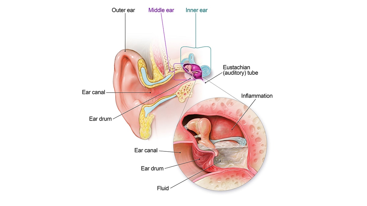Anatomy of the ear showing where fluid builds up in the middle ear and puts pressure, or pushes, on the ear.