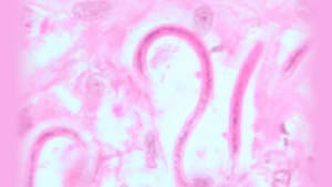 Microfilariae of O. volvulus from a skin nodule.