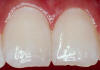 Image of questionable fluorosis. Teeth show some slight differences from normal translucent appearance. Some white spots are apparent but not enough to warrant a diagnosis of very mild fluorosis.