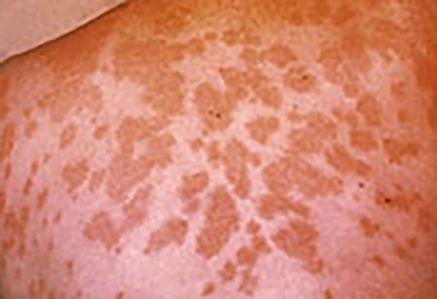 phil-482_lores-cdcwp1490010117949 Rash (erythema nodosum) due to Valley fever.