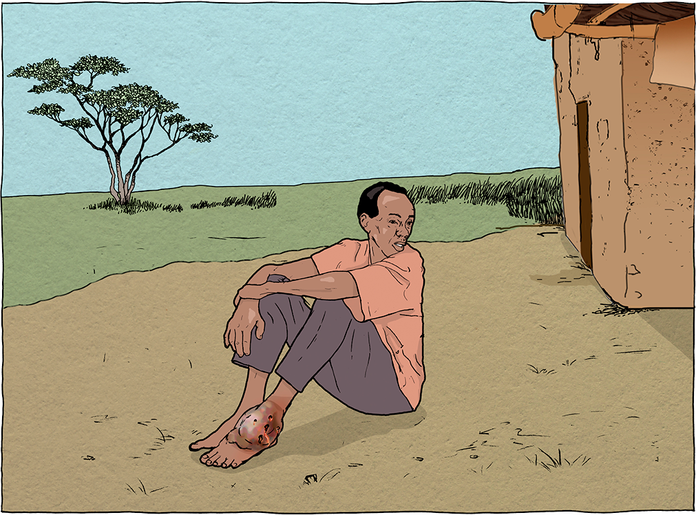 Mycetoma Graphic of a man sitting on the ground with mycetoma on his foot.