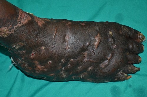 mycetoma-foot-300px Massive eumycetoma of the right foot in a 40 year-old male patient from central Sudan caused by Madurella mycetomatis. Photo by Dr. Fahal, Mycetoma Research Center, Khartoum, Sudan