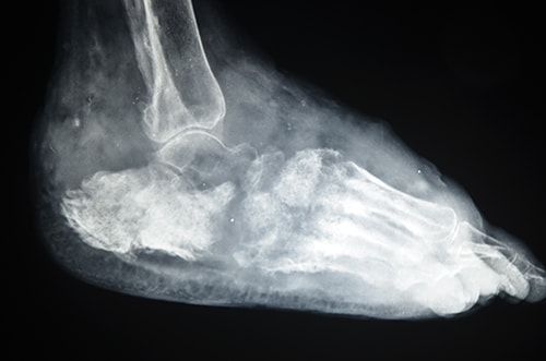 mycetoma-foot-xray-300px Placeholder for caption. Photo by Dr. Fahal, Mycetoma Research Center, Khartoum, Sudan