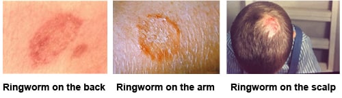 ringworm-composite-500px.jpg Composite image. First image has ringworm on the back. Second image has ringworm on the arm. Third image has ringworm on the scalp