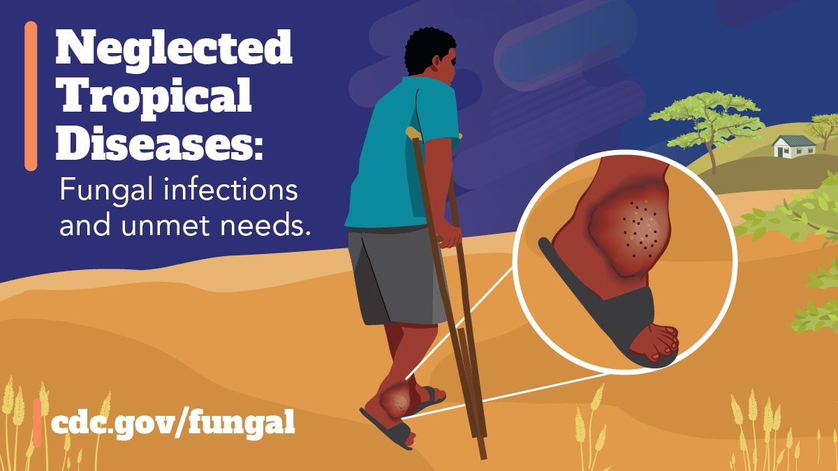Neglected Tropical Diseases (Facebook) A person using crutches and wearing open toed shoes walking through a rural, arid area. The person’s lower extremity is visibly affected by a fungal infection and is magnified showing skin lesions on their ankle. Text reads. “Neglected tropical diseases: fungal infections and unmet needs.”