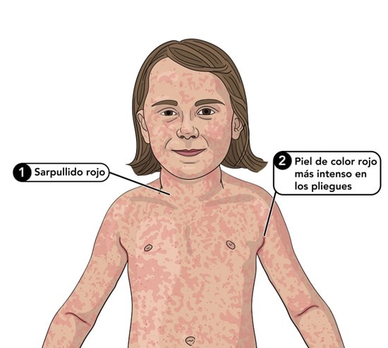336119_scarlet_fever_rash_pastia_lines_labels_es2.jpg Ilustración de un niño con salpullido por escarlatina.