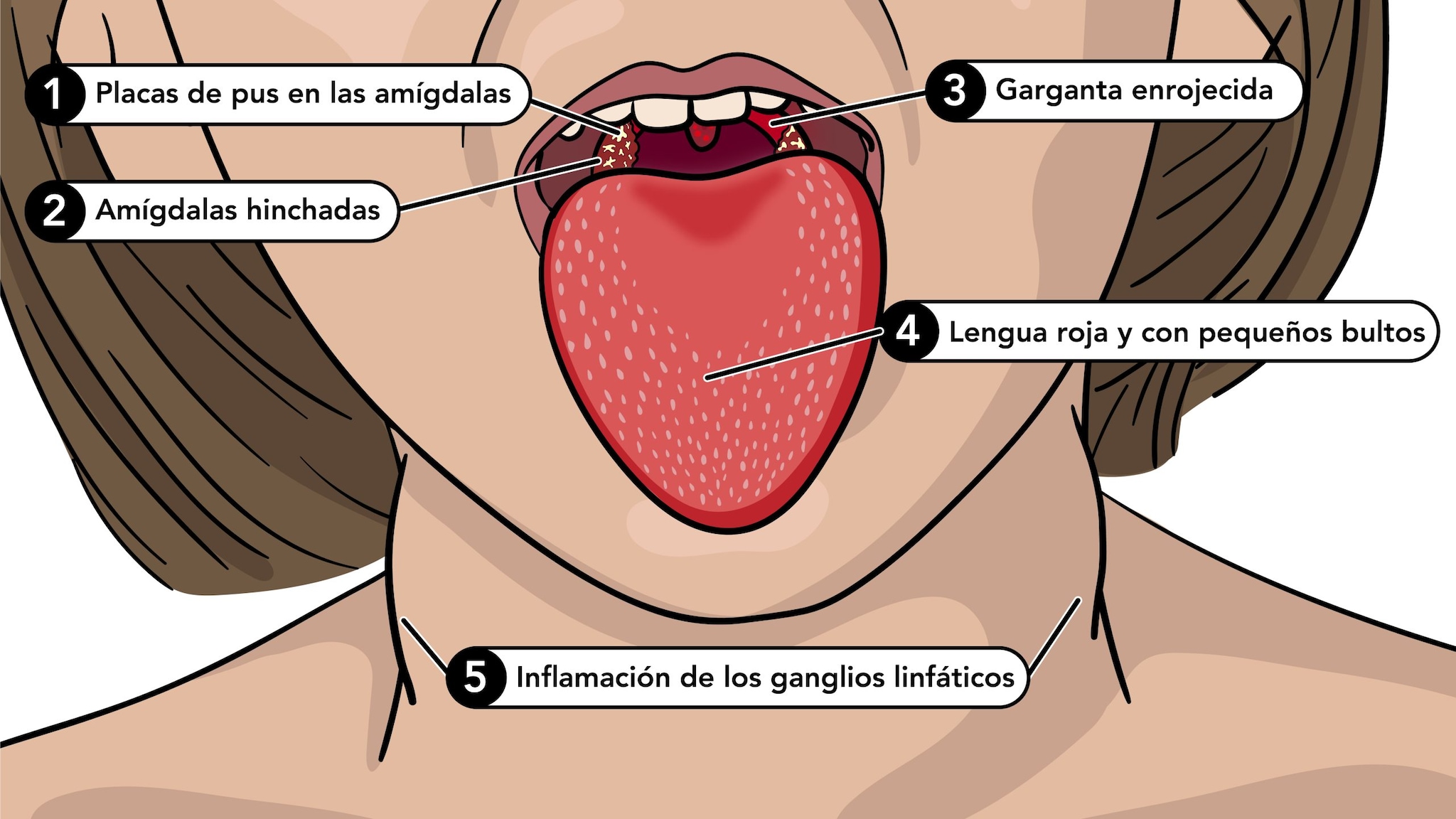 336119_scarlet_fever_strawberry_tongue_labels_es.jpg Los síntomas de la escarlatina incluyen la lengua roja y con pequeños bultos, garganta roja, amigdalas hinchadas y glangeos linfáticos inflamados.