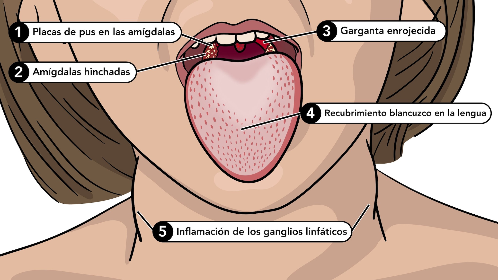 336119_scarlet_fever_white_tongue_labels_es.jpg Los síntomas de la escarlatina incluyen lengua blanca, garganta roja, amigdalas hinchadas y ganglios linfáticos inflamados.