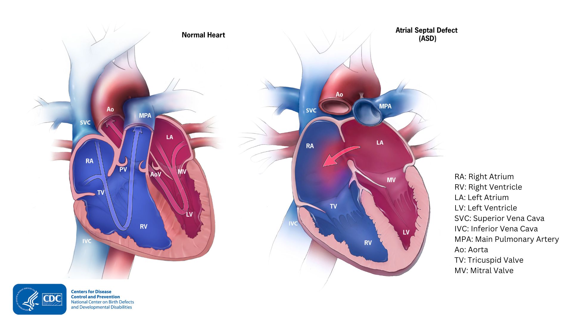 Comparison of a normal heart and one with an ASD